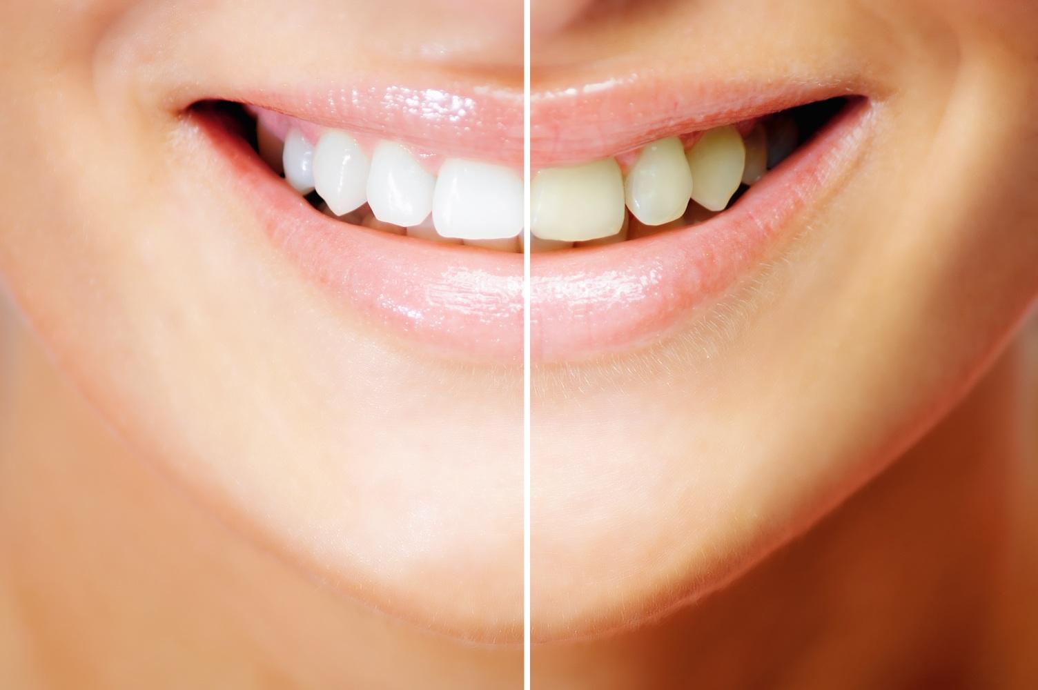 teeth-whitening-results2